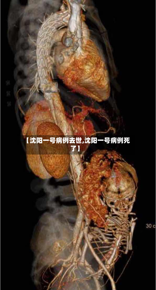 【沈阳一号病例去世,沈阳一号病例死了】