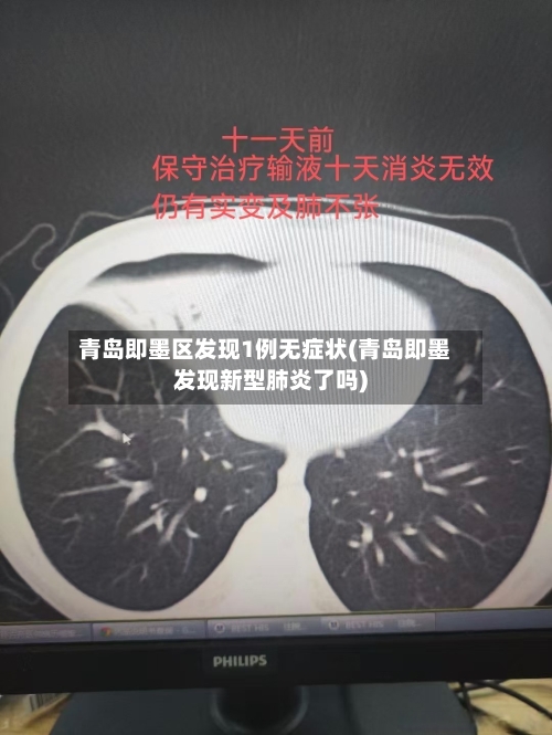 青岛即墨区发现1例无症状(青岛即墨发现新型肺炎了吗)