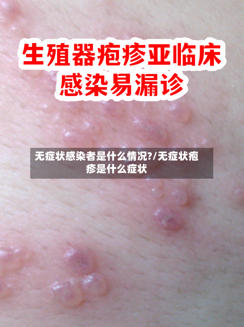 无症状感染者是什么情况?/无症状疱疹是什么症状
