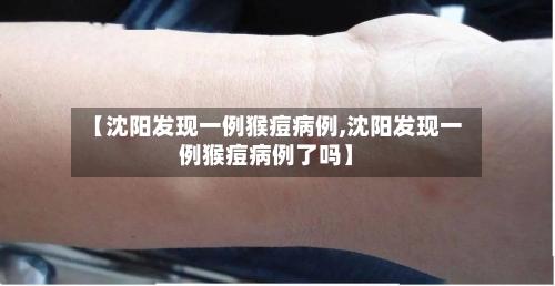 【沈阳发现一例猴痘病例,沈阳发现一例猴痘病例了吗】-第2张图片