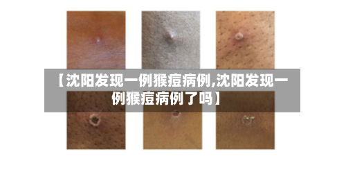 【沈阳发现一例猴痘病例,沈阳发现一例猴痘病例了吗】