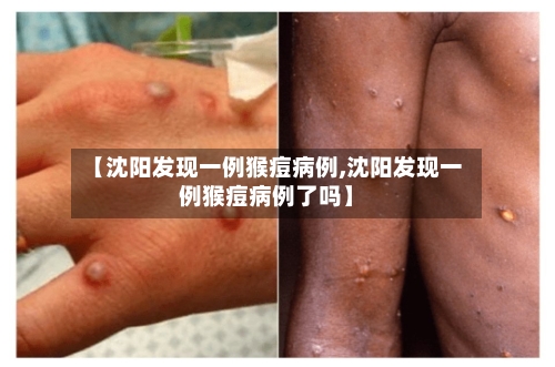 【沈阳发现一例猴痘病例,沈阳发现一例猴痘病例了吗】-第3张图片