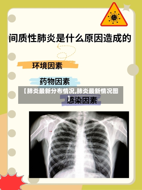 【肺炎最新分布情况,肺炎最新情况图】