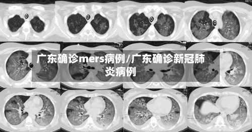广东确诊mers病例/广东确诊新冠肺炎病例