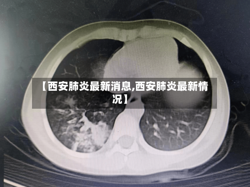【西安肺炎最新消息,西安肺炎最新情况】
