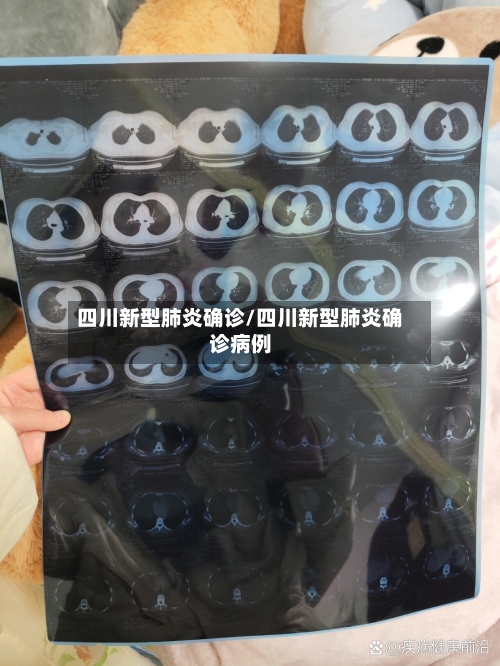 四川新型肺炎确诊/四川新型肺炎确诊病例-第2张图片