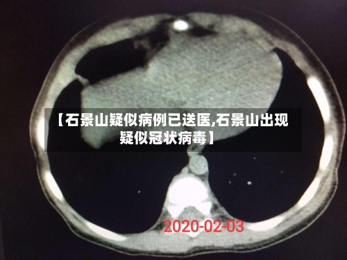 【石景山疑似病例已送医,石景山出现疑似冠状病毒】