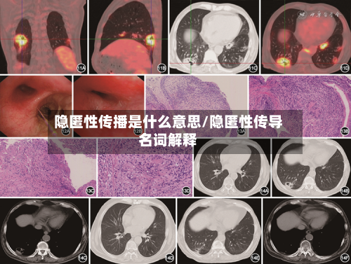 隐匿性传播是什么意思/隐匿性传导名词解释-第3张图片