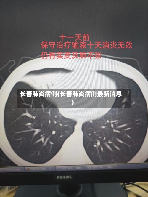 长春肺炎病例(长春肺炎病例最新消息)-第2张图片