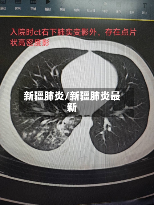 新疆肺炎/新疆肺炎最新