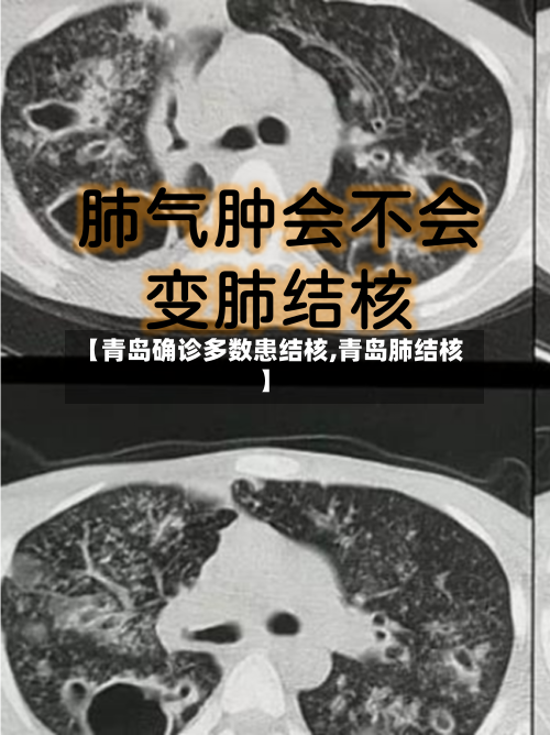 【青岛确诊多数患结核,青岛肺结核】-第3张图片