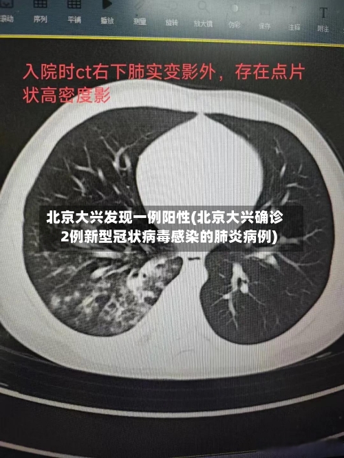 北京大兴发现一例阳性(北京大兴确诊2例新型冠状病毒感染的肺炎病例)