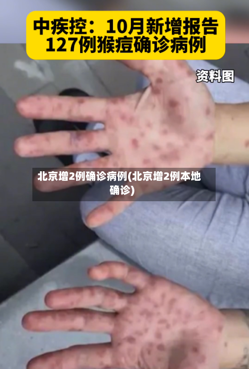 北京增2例确诊病例(北京增2例本地确诊)