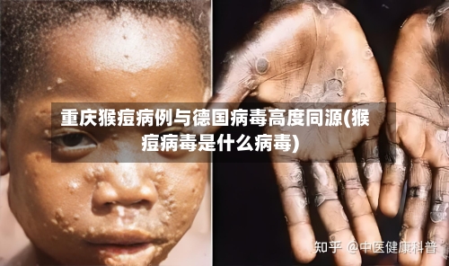 重庆猴痘病例与德国病毒高度同源(猴痘病毒是什么病毒)-第2张图片