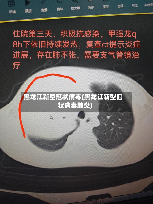 黑龙江新型冠状病毒(黑龙江新型冠状病毒肺炎)-第2张图片
