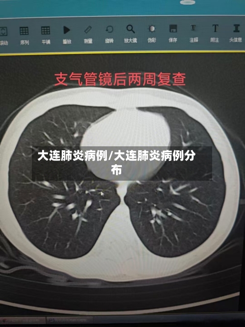 大连肺炎病例/大连肺炎病例分布