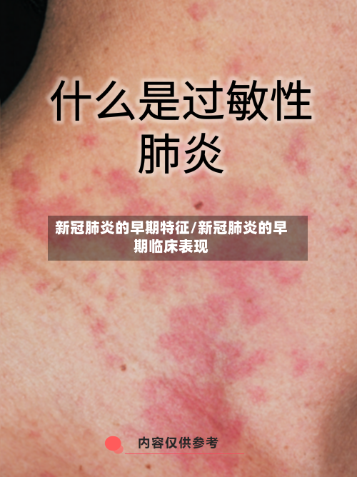 新冠肺炎的早期特征/新冠肺炎的早期临床表现-第2张图片