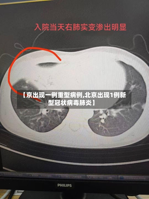 【京出现一例重型病例,北京出现1例新型冠状病毒肺炎】-第3张图片