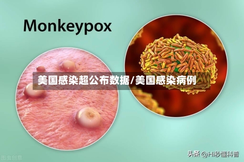 美国感染超公布数据/美国感染病例-第3张图片