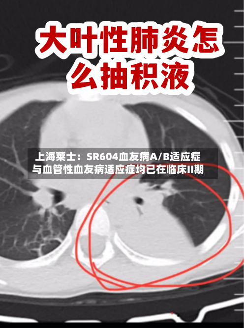 上海莱士：SR604血友病A/B适应症与血管性血友病适应症均已在临床II期