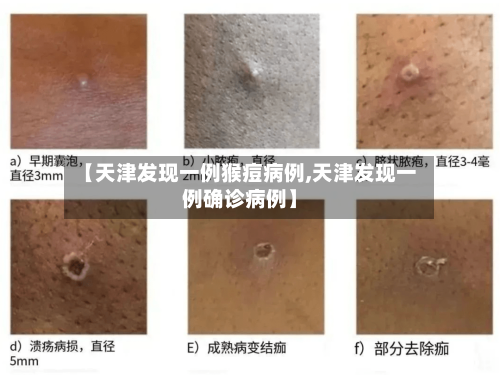 【天津发现一例猴痘病例,天津发现一例确诊病例】-第3张图片