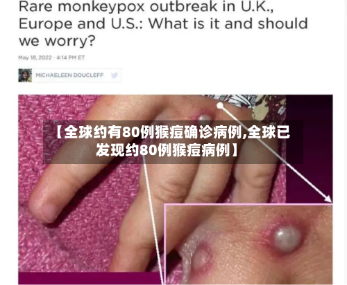 【全球约有80例猴痘确诊病例,全球已发现约80例猴痘病例】-第3张图片