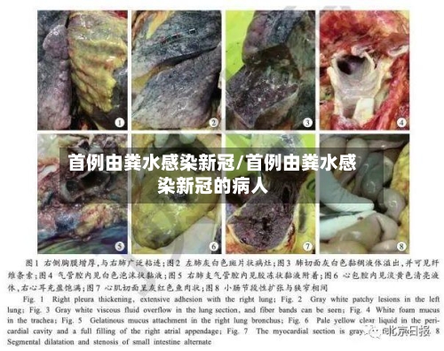 首例由粪水感染新冠/首例由粪水感染新冠的病人