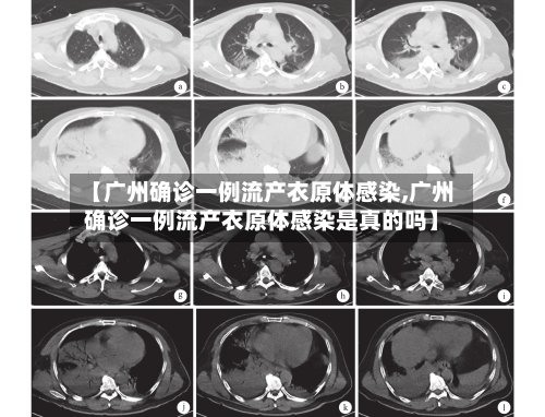【广州确诊一例流产衣原体感染,广州确诊一例流产衣原体感染是真的吗】-第2张图片