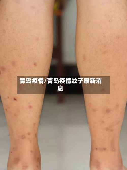 青岛疫情/青岛疫情蚊子最新消息-第2张图片