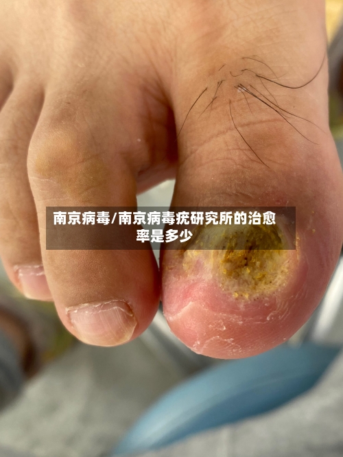南京病毒/南京病毒疣研究所的治愈率是多少
