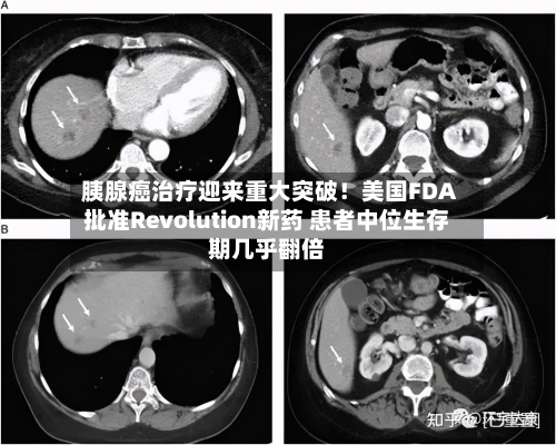 胰腺癌治疗迎来重大突破！美国FDA批准Revolution新药 患者中位生存期几乎翻倍-第2张图片